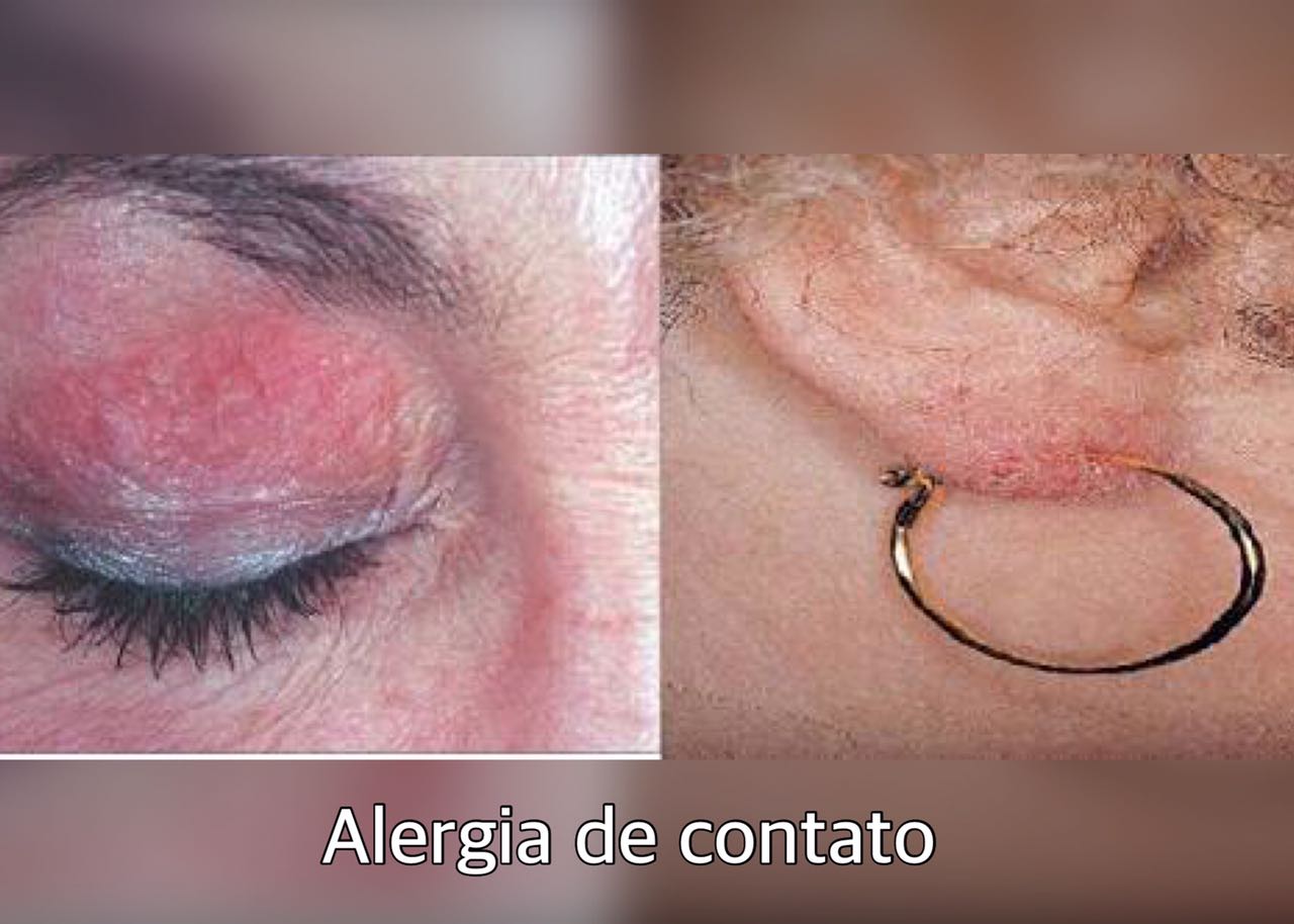 Alergia de Contato