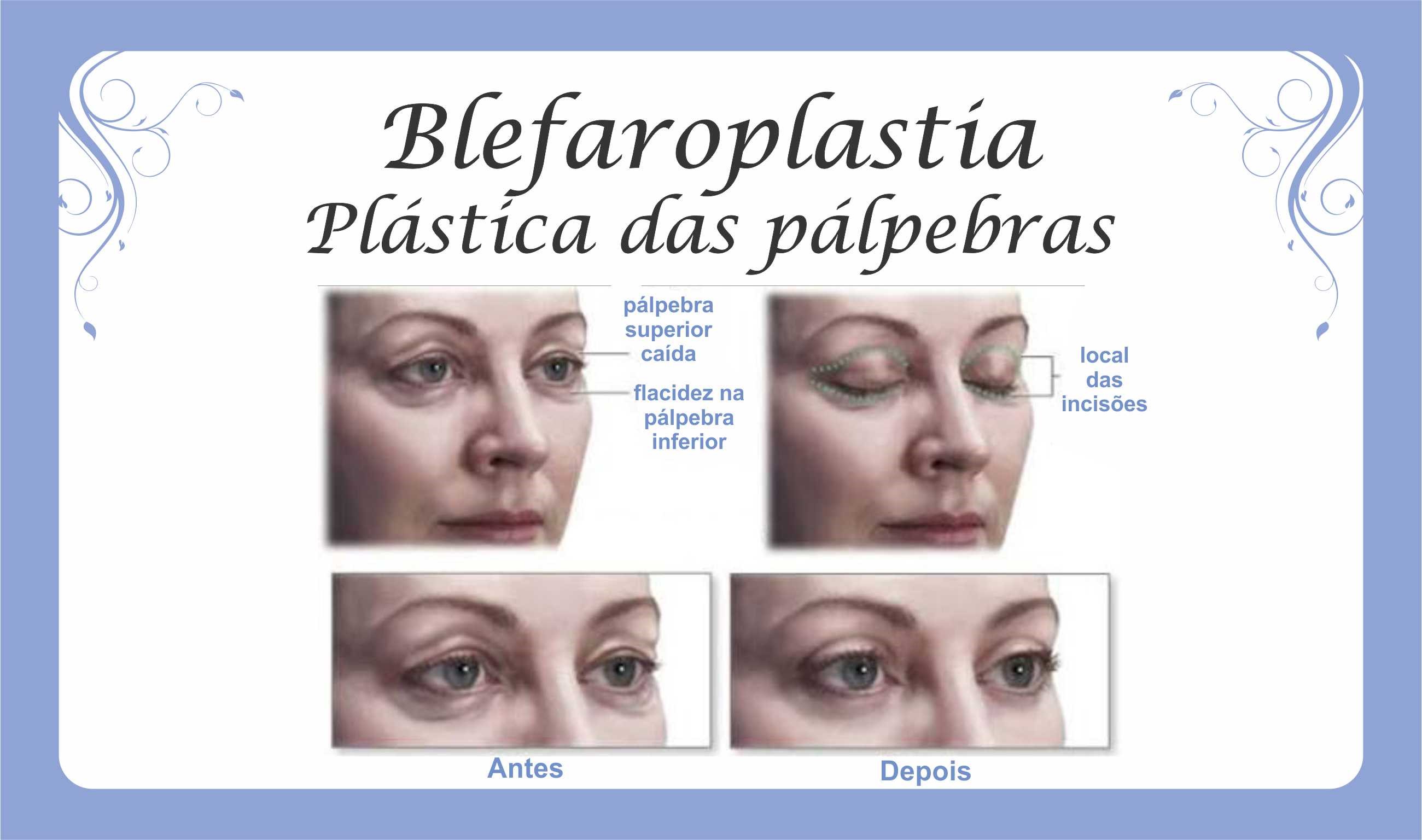 Blefaroplastia - Plástica das Pálpebras Blefaroplastia - Plástica das Pálpebras
