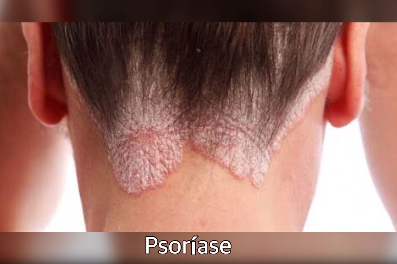 Psoríase