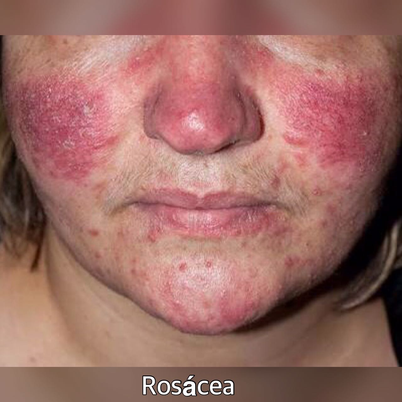 Rosacea